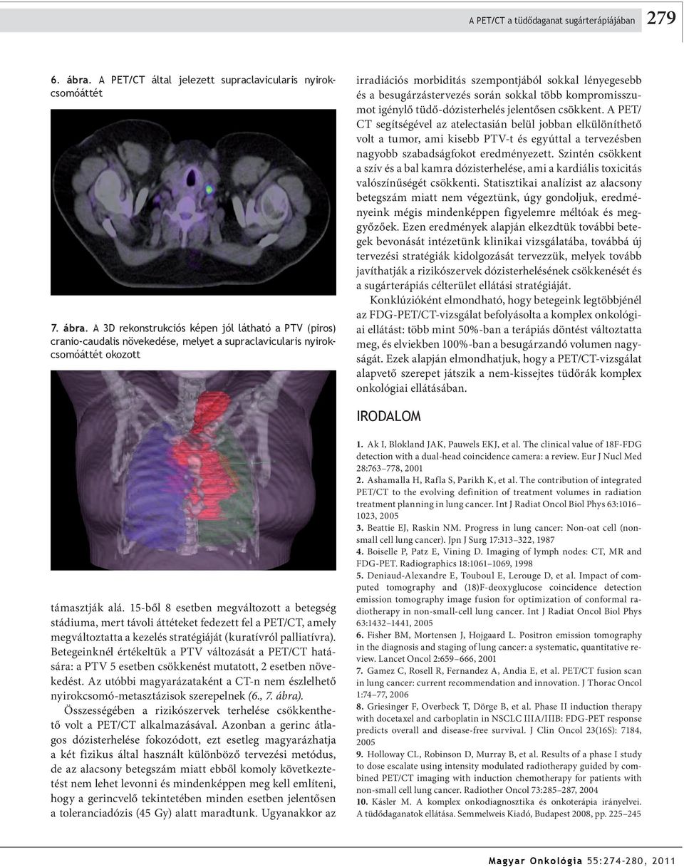 A 3D rekonstrukciós képen jól látható a PTV (piros) cranio-caudalis növekedése, melyet a supraclavicularis nyirokcsomóáttét okozott irradiációs morbiditás szempontjából sokkal lényegesebb és a