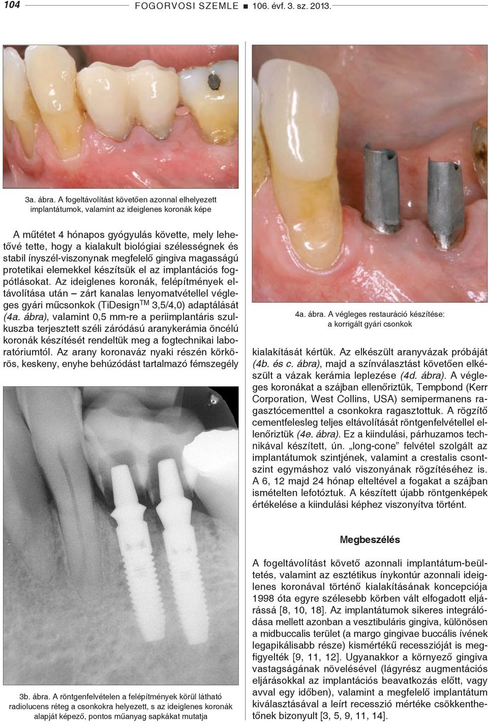 és stabil ínyszél-viszonynak megfelelő gingiva magasságú protetikai elemekkel készítsük el az implantációs fogpótlásokat.