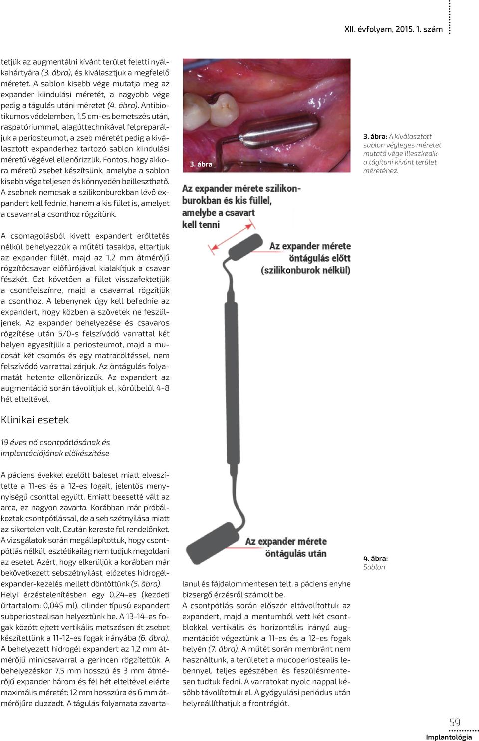 Antibiotikumos védelemben, 1,5 cm-es bemetszés után, raspatóriummal, alagúttechnikával felpreparáljuk a periosteumot, a zseb méretét pedig a kiválasztott expanderhez tartozó sablon kiindulási méretű