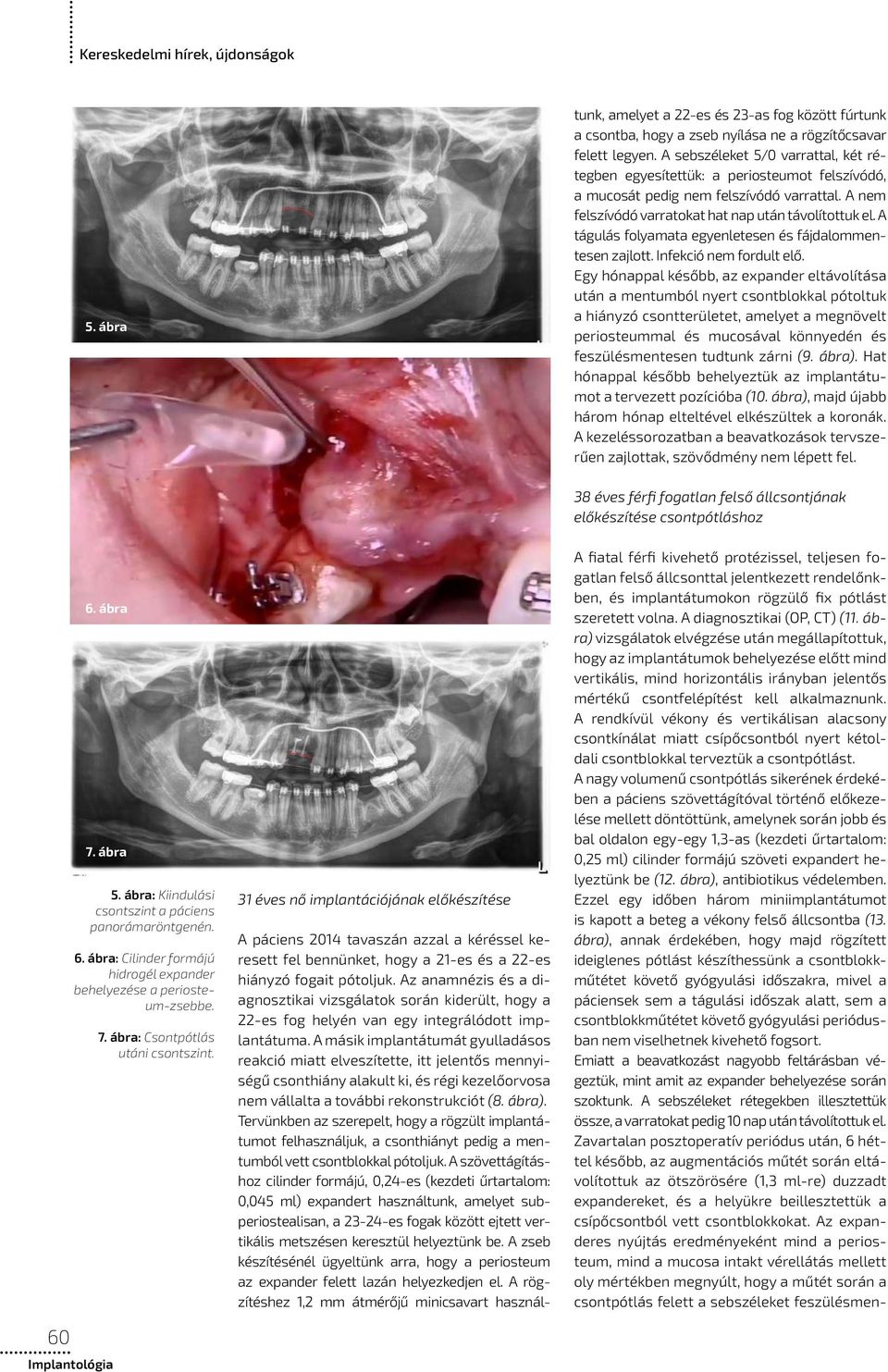 A másik implantátumát gyulladásos reakció miatt elveszítette, itt jelentős mennyiségű csonthiány alakult ki, és régi kezelőorvosa nem vállalta a további rekonstrukciót (8. ábra).