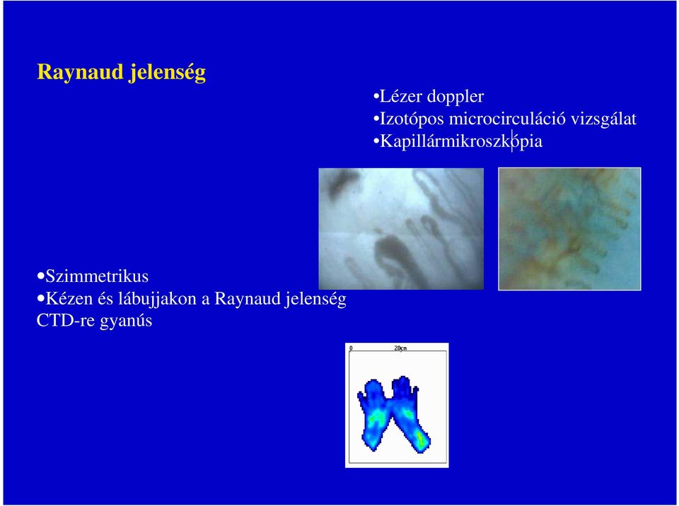 Kapillármikroszkópia Szimmetrikus
