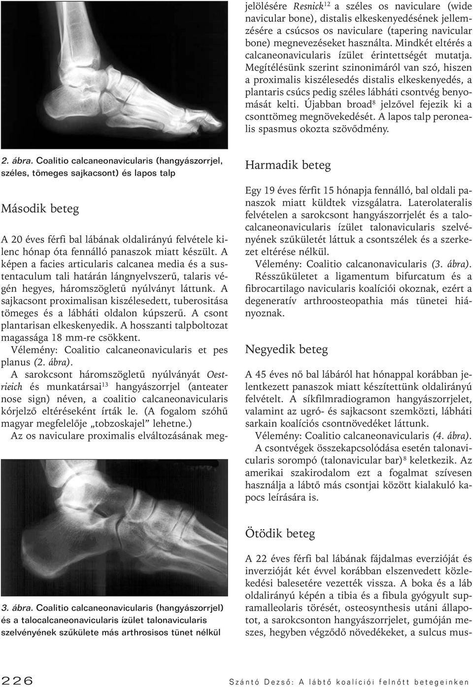 Megítélésünk szerint szinonimáról van szó, hiszen a proximalis kiszélesedés distalis elkeskenyedés, a plantaris csúcs pedig széles lábháti csontvég benyomását kelti.