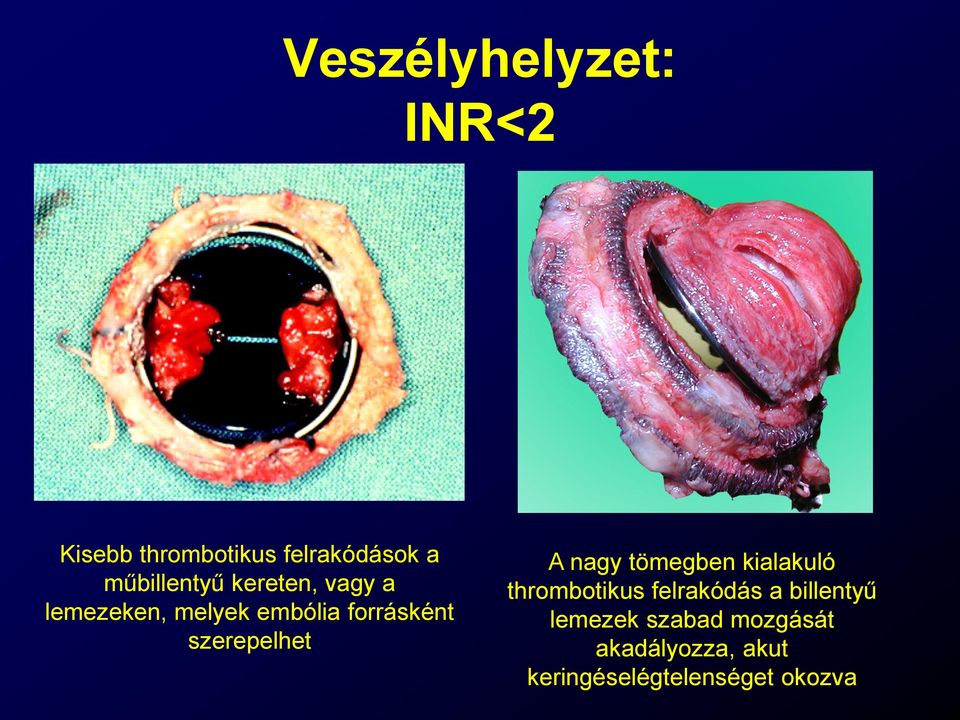 szerepelhet A nagy tömegben kialakuló thrombotikus felrakódás a