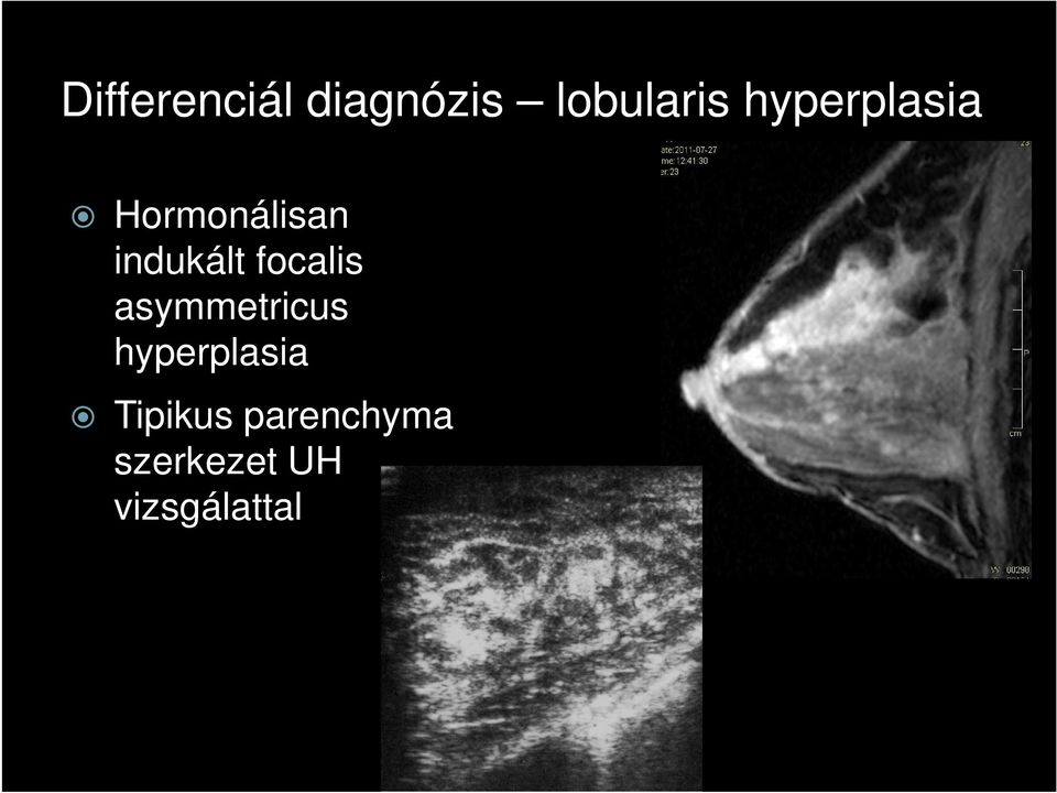 focalis asymmetricus hyperplasia