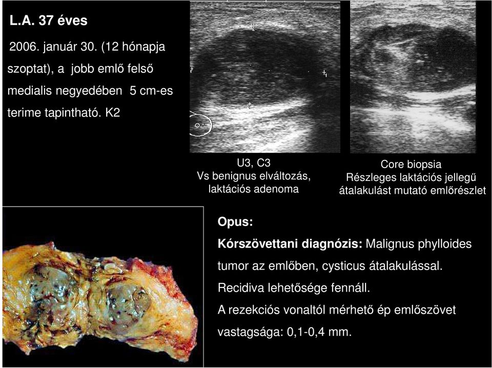 K2 U3, C3 Vs benignus elváltozás, laktációs adenoma Core biopsia Részleges laktációs jellegű átalakulást