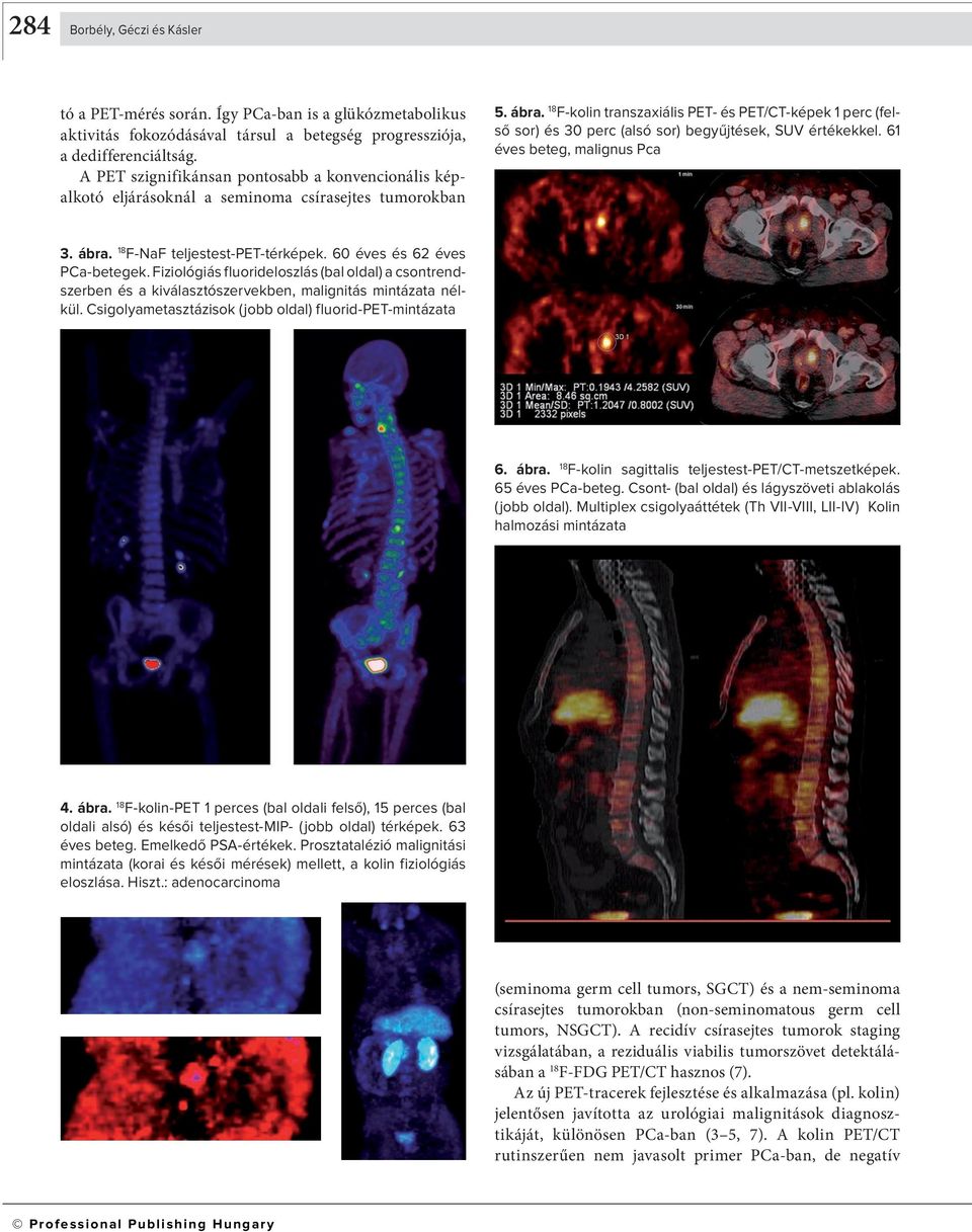 F-kolin transzaxiális PET- és PET/CT-képek 1 perc (felső sor) és 30 perc (alsó sor) begyűjtések, SUV értékekkel. 61 éves beteg, malignus Pca 3. ábra. F-NaF teljestest-pet-térképek.