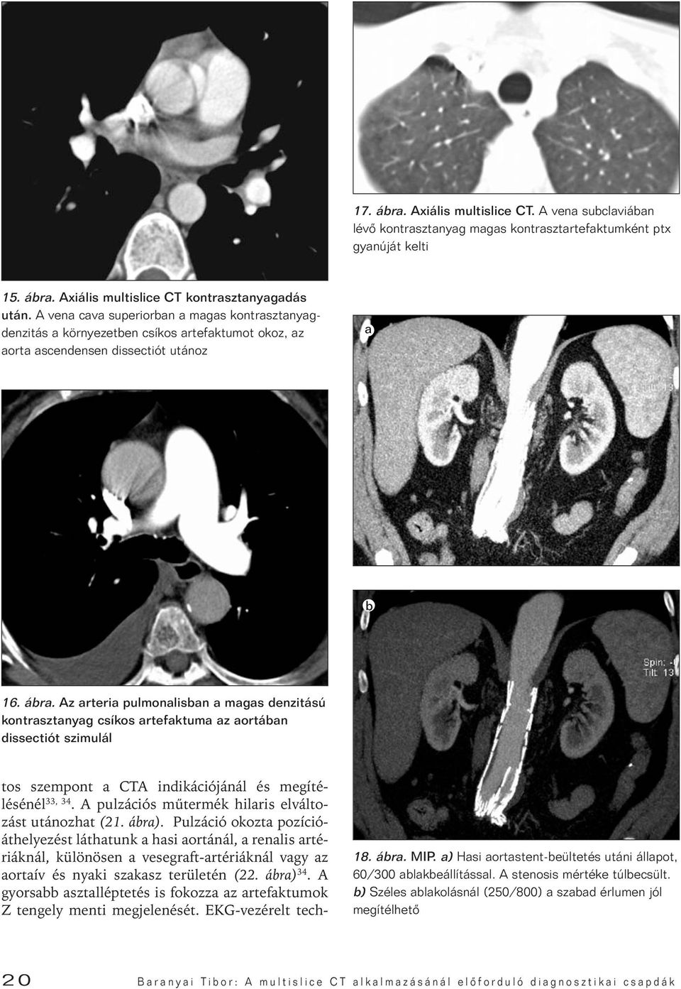 Az arteria pulmonalisban a magas denzitású kontrasztanyag csíkos artefaktuma az aortában dissectiót szimulál tos szempont a CTA indikációjánál és megítélésénél 33, 34.