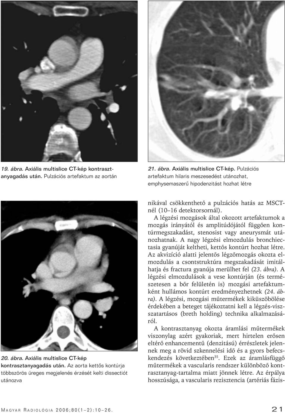 Az aorta kettôs kontúrja többszörös üreges megjelenés érzését kelti dissectiót utánozva nikával csökkenthetô a pulzációs hatás az MSCTnél (10 16 detektorsornál).