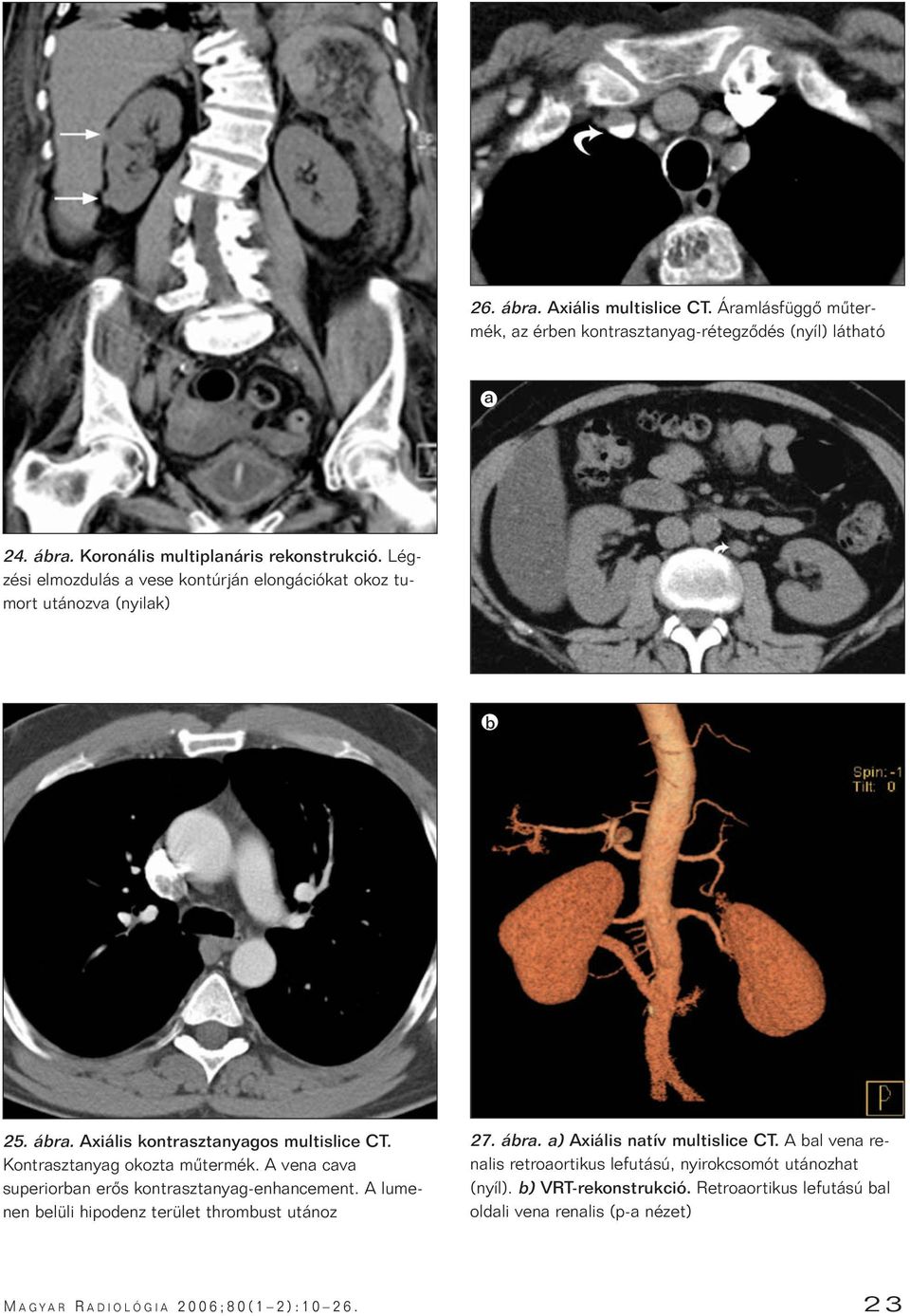 A vena cava superiorban erôs kontrasztanyag-enhancement. A lumenen belüli hipodenz terület thrombust utánoz 27. ábra. a) Axiális natív multislice CT.