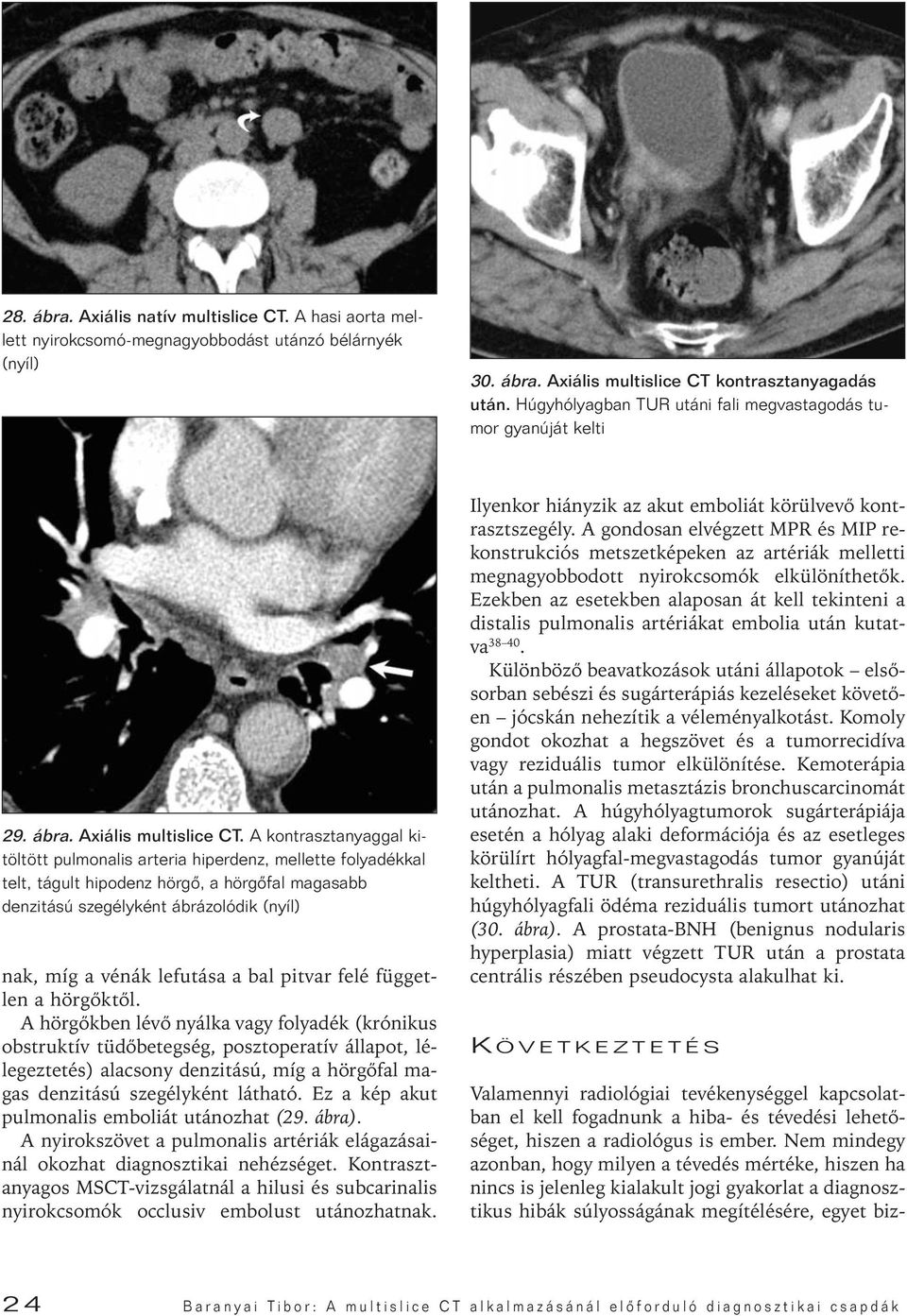 A kontrasztanyaggal kitöltött pulmonalis arteria hiperdenz, mellette folyadékkal telt, tágult hipodenz hörgô, a hörgôfal magasabb denzitású szegélyként ábrázolódik (nyíl) nak, míg a vénák lefutása a