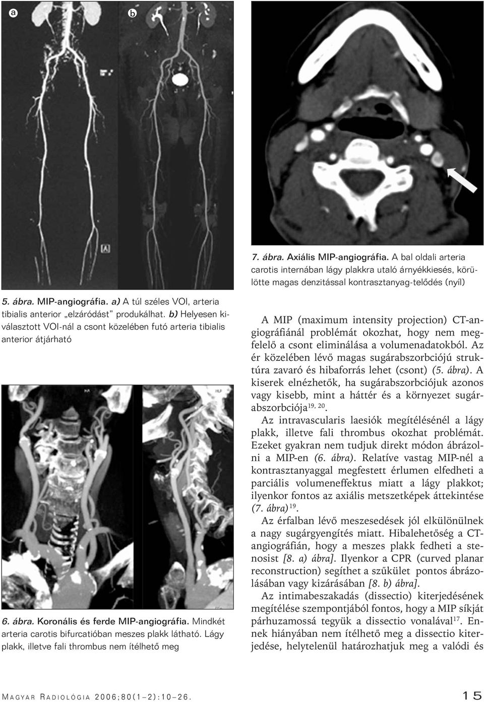 Lágy plakk, illetve fali thrombus nem ítélhetô meg A MIP (maximum intensity projection) CT-angiográfiánál problémát okozhat, hogy nem megfelelô a csont eliminálása a volumenadatokból.