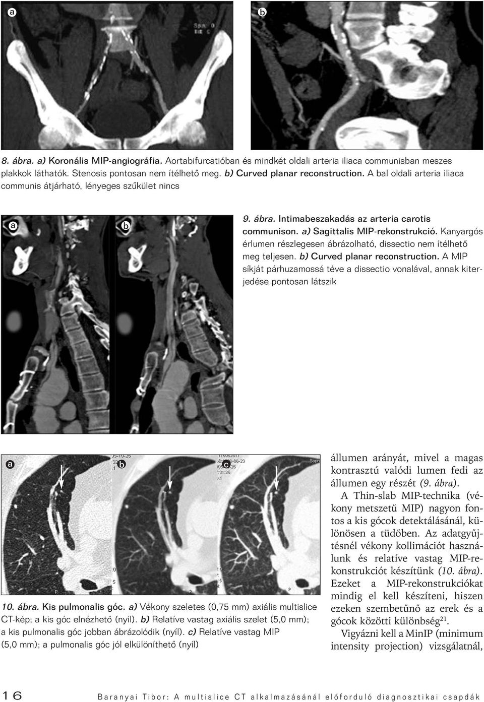 Kanyargós érlumen részlegesen ábrázolható, dissectio nem ítélhetô meg teljesen. b) Curved planar reconstruction.