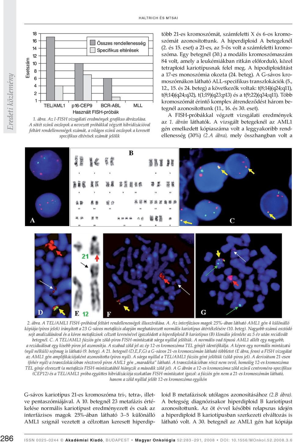 számfeletti X és 6-os kromoszómát azonosítottunk. A hiperdiploid A betegeknél (2. és 15. eset) a 21-es, az 5-ös volt a számfeletti kromoszóma. Egy betegnél (30.