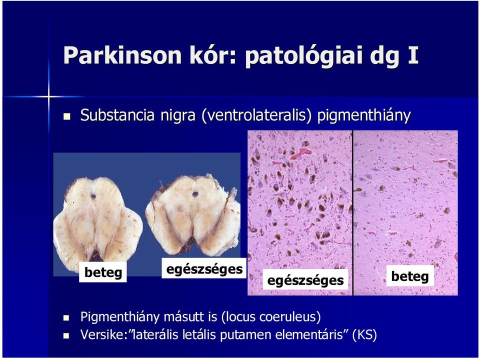 egészséges beteg Pigmenthiányny másutt is (locus