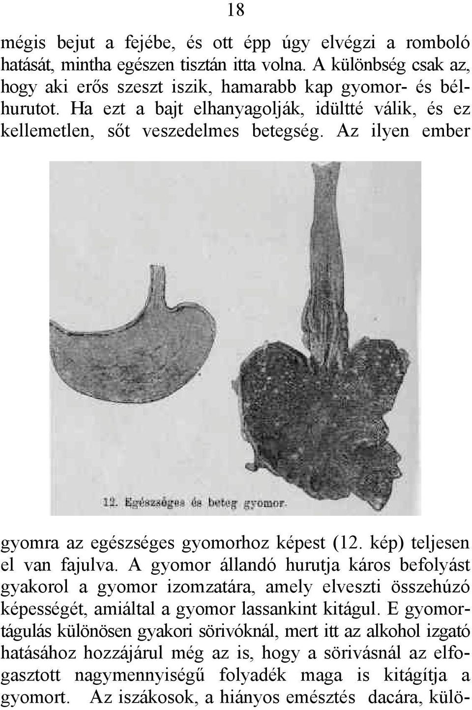 A gyomor állandó hurutja káros befolyást gyakorol a gyomor izomzatára, amely elveszti összehúzó képességét, amiáltal a gyomor lassankint kitágul.