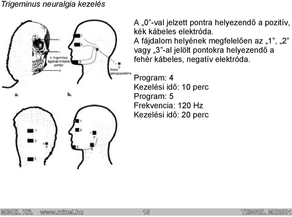 A fájdalom helyének megfelelően az 1, 2 vagy 3 -al jelölt pontokra helyezendő a