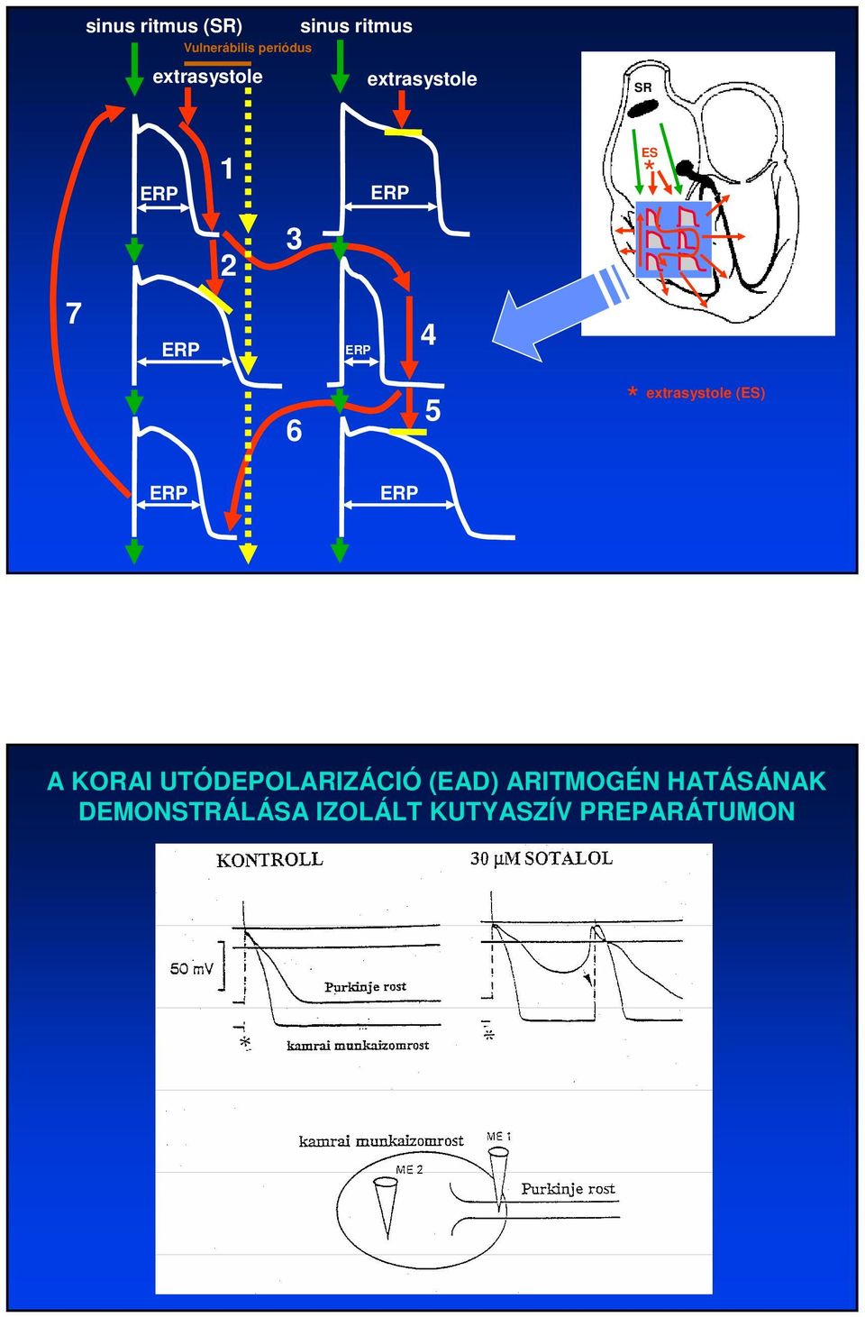 6 5 * extrasystole (ES) ERP ERP A KORAI UTÓDEPOLARIZÁCIÓ