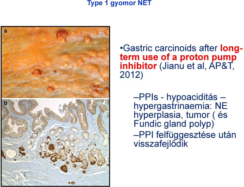 hypoaciditás hypergastrinaemia: NE hyperplasia, tumor ( és