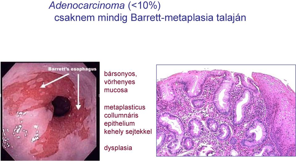 vörhenyes mucosa metaplasticus