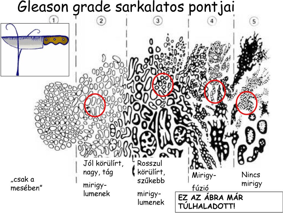 körülírt, szűkebb mirigylumenek