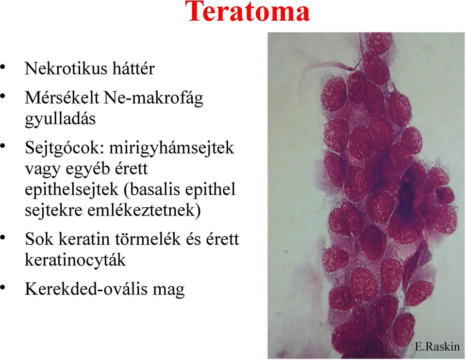 epithelsejtek (basalis epithel sejtekre emlékeztetnek)