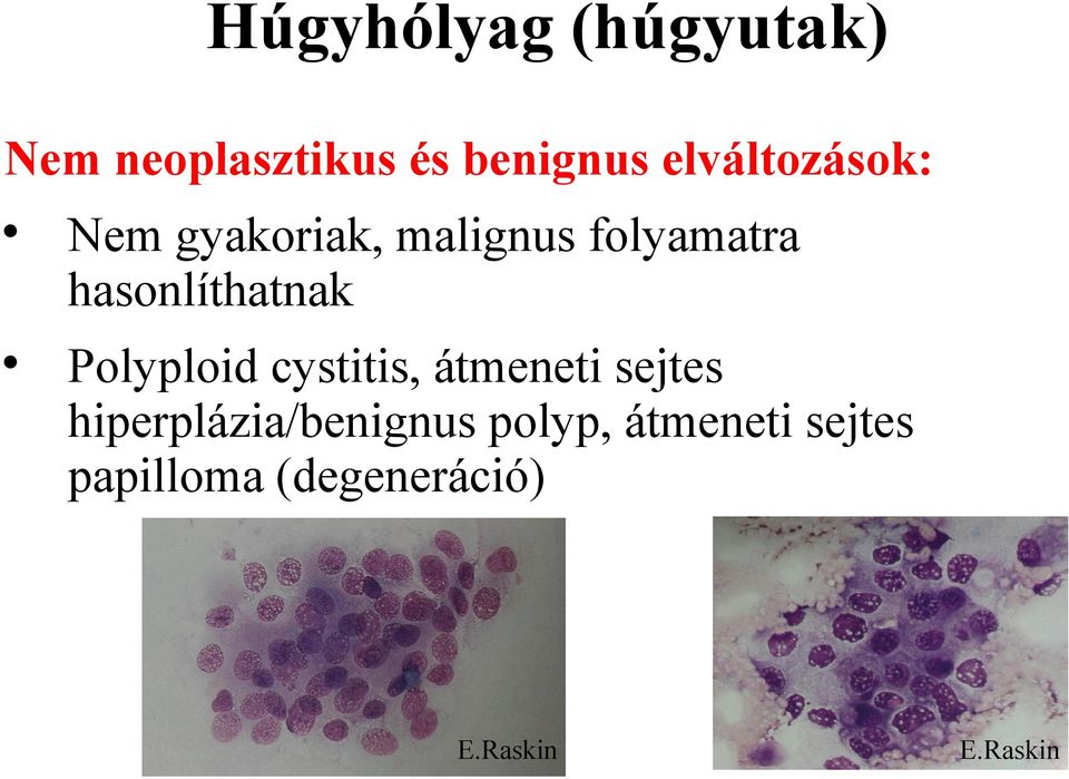 hasonlíthatnak Polyploid cystitis, átmeneti sejtes