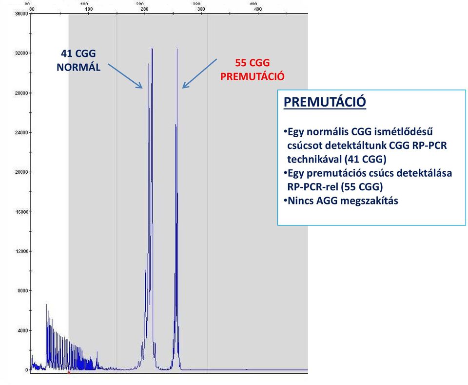csúcsot detektáltunk CGG RP-PCR technikával (41 CGG) Egy