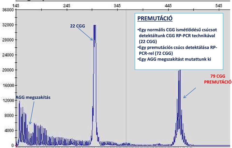 premutációs csúcs detektálása RP- PCR-rel(72 CGG) Egy