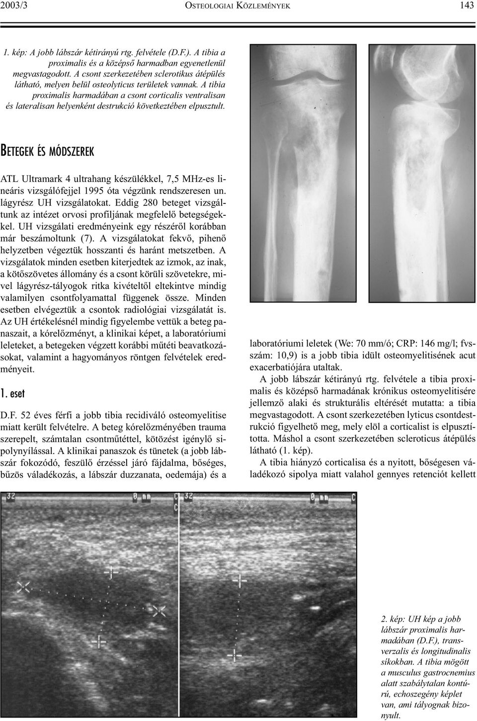 A tibia proximalis harmadában a csont corticalis ventralisan és lateralisan helyenként destrukció következtében elpusztult.