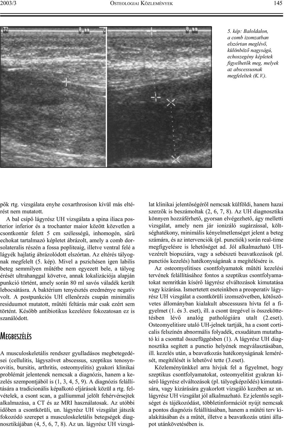 A bal csípõ lágyrész UH vizsgálata a spina iliaca posterior inferior és a trochanter maior között közvetlen a csontkontúr felett 5 cm szélességû, inhomogén, sûrû echokat tartalmazó képletet ábrázolt,