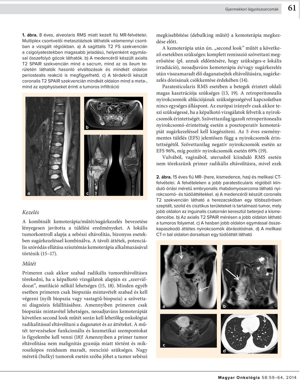 b) A medencéről készült axialis T2 SPAIR szekvencián mind a sacrum, mind az os ileum területén láthatók hasonló elváltozások és mindkét oldalon periostealis reakció is megfigyelhető.