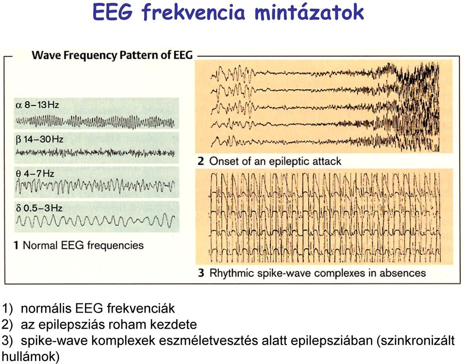 kezdete 3) spike-wave komplexek