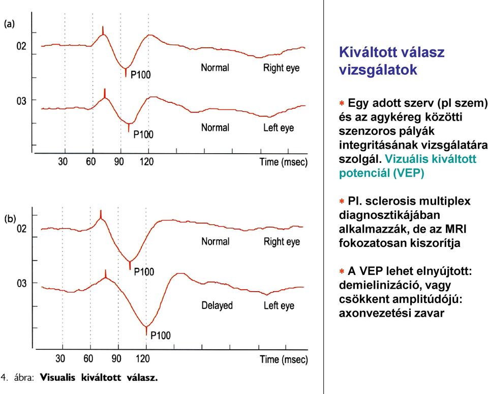 Vizuális kiváltott potenciál (VEP) Pl.