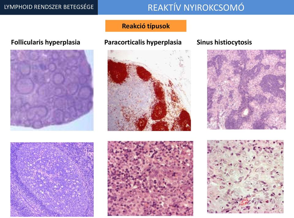 típusok Follicularis hyperplasia