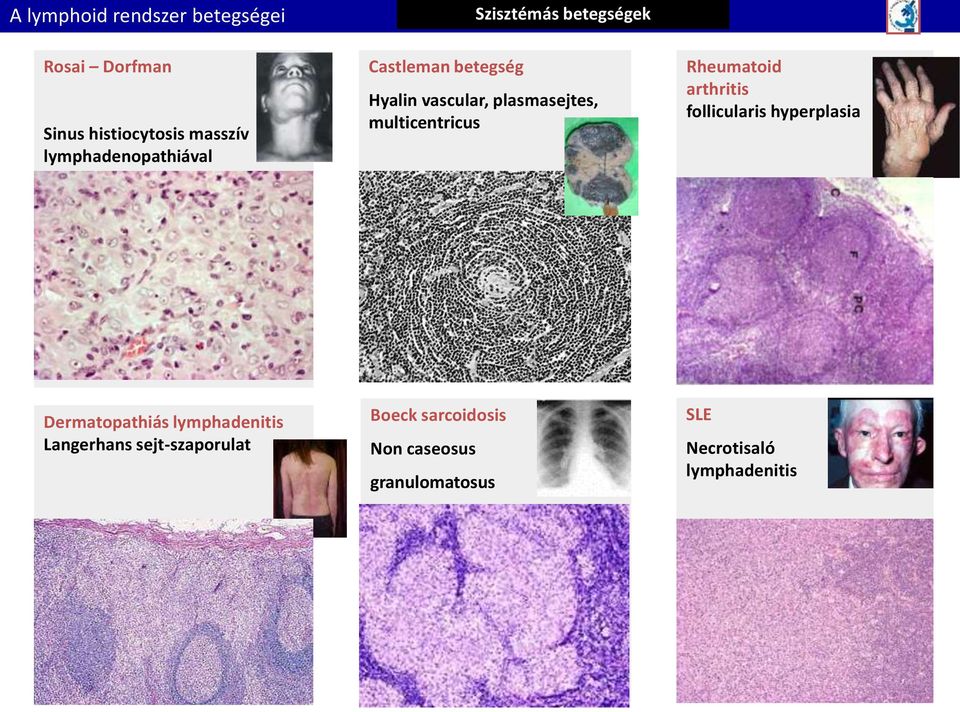 Rheumatoid arthritis follicularis hyperplasia Dermatopathiás lymphadenitis Langerhans