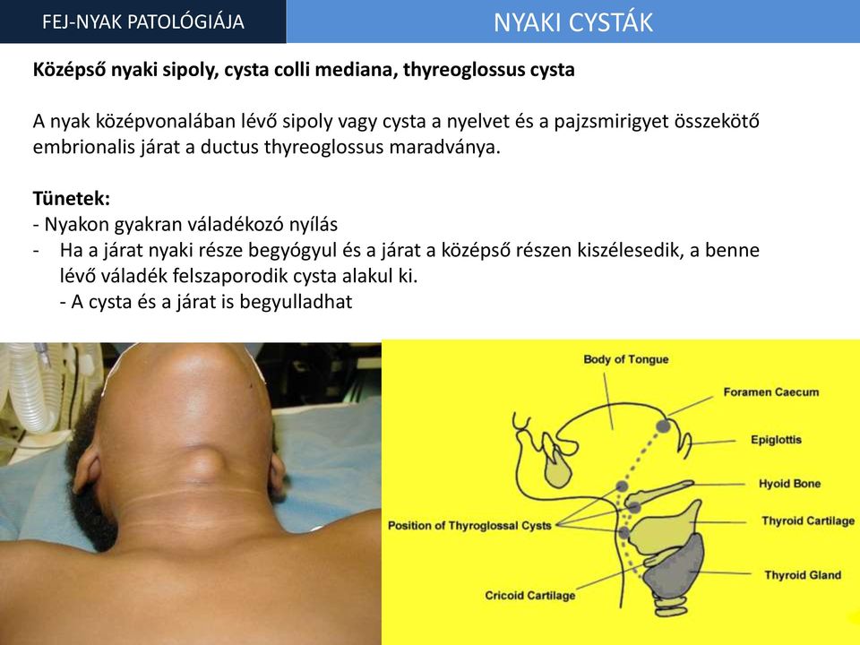 thyreoglossus maradványa.