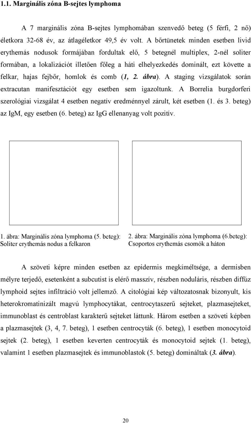 felkar, hajas fejbőr, homlok és comb (1, 2. ábra). A staging vizsgálatok során extracutan manifesztációt egy esetben sem igazoltunk.