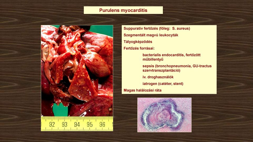 bacterialis endocarditis, fertőzött műbillentyű sepsis (bronchopneumonia,