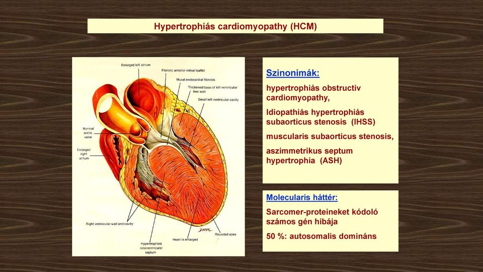 muscularis subaorticus stenosis, aszimmetrikus septum hypertrophia (ASH)