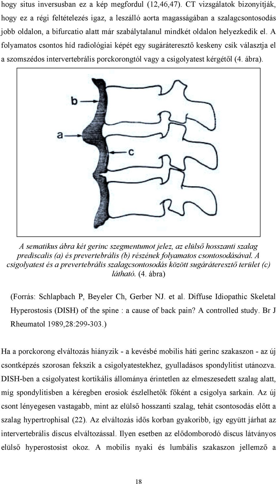A folyamatos csontos híd radiológiai képét egy sugáráteresztő keskeny csík választja el a szomszédos intervertebrális porckorongtól vagy a csigolyatest kérgétől (4. ábra).