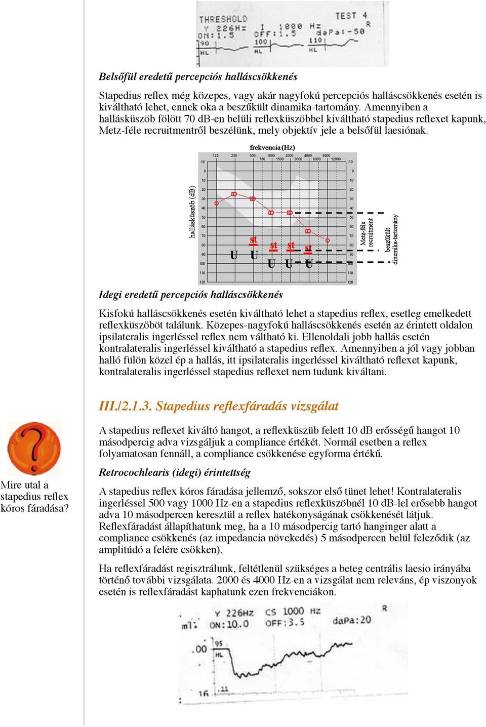 Idegi eredetű percepciós halláscsökkenés Kisfokú halláscsökkenés esetén kiváltható lehet a stapedius reflex, esetleg emelkedett reflexküszöböt találunk.