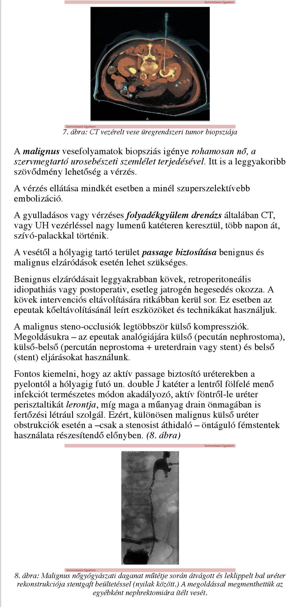 A gyulladásos vagy vérzéses folyadékgyülem drenázs általában CT, vagy UH vezérléssel nagy lumenű katéteren keresztül, több napon át, szívó-palackkal történik.