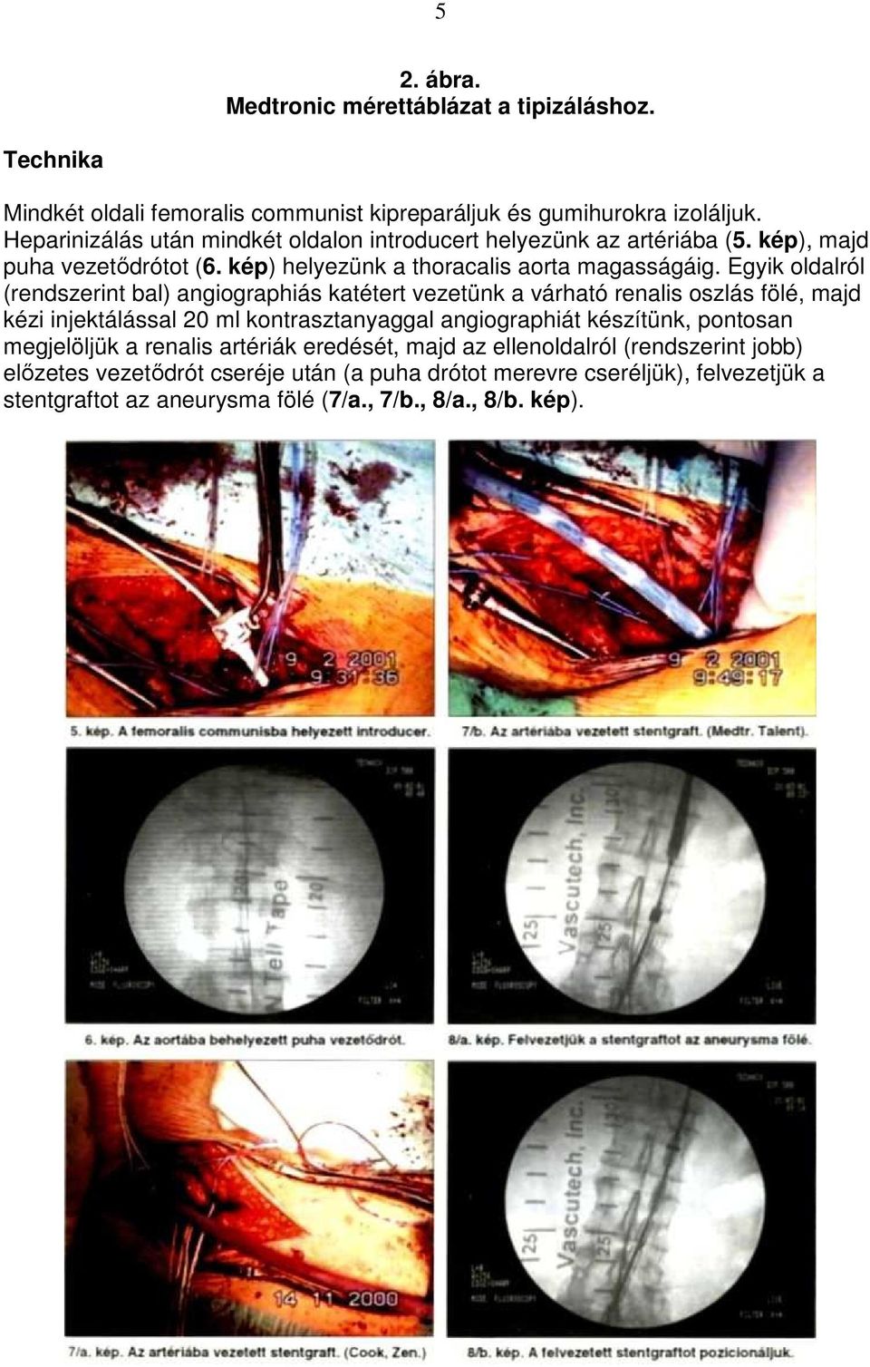 Egyik oldalról (rendszerint bal) angiographiás katétert vezetünk a várható renalis oszlás fölé, majd kézi injektálással 20 ml kontrasztanyaggal angiographiát készítünk,