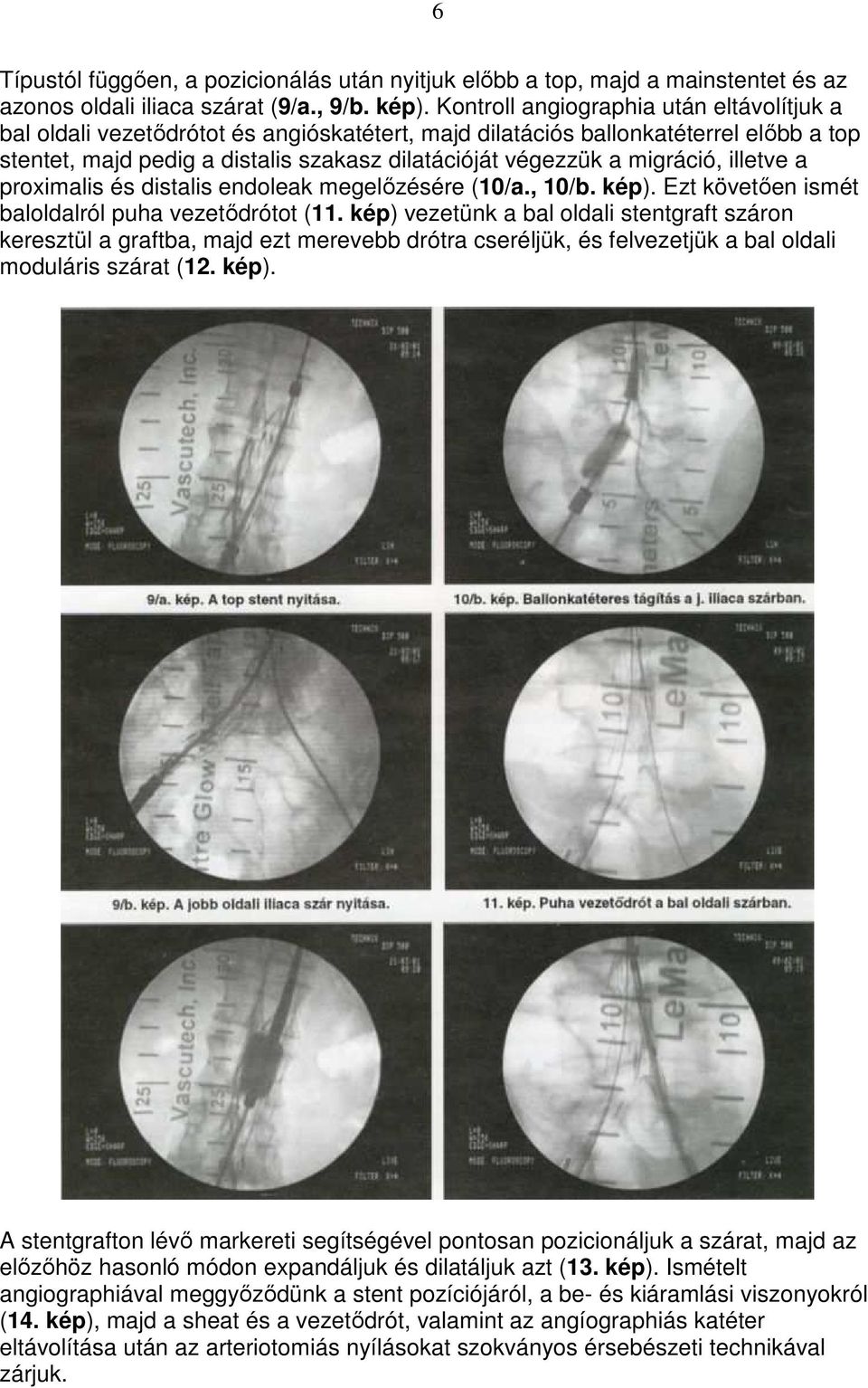 migráció, illetve a proximalis és distalis endoleak megelızésére (10/a., 10/b. kép). Ezt követıen ismét baloldalról puha vezetıdrótot (11.