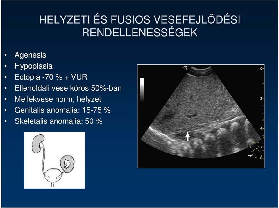 Ellenoldali vese kórós 50%-ban Mellékvese norm,