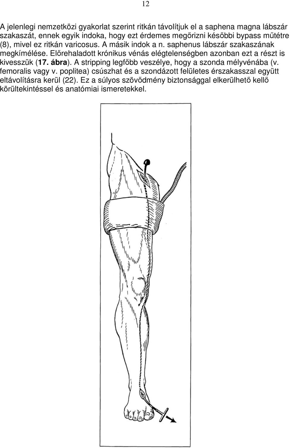 Elırehaladott krónikus vénás elégtelenségben azonban ezt a részt is kivesszük (17. ábra). A stripping legfıbb veszélye, hogy a szonda mélyvénába (v.