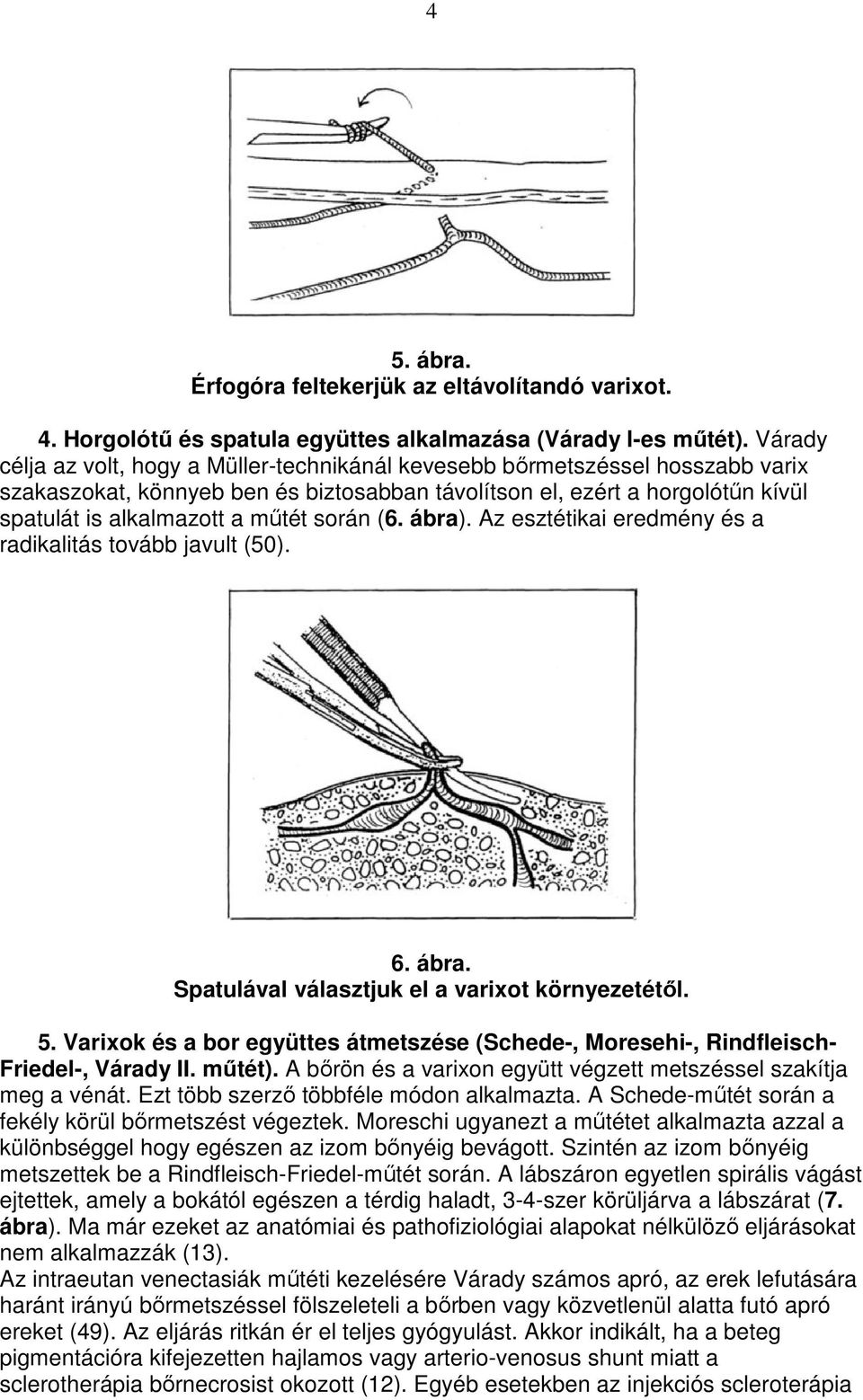 során (6. ábra). Az esztétikai eredmény és a radikalitás tovább javult (50). 6. ábra. Spatulával választjuk el a varixot környezetétıl. 5.