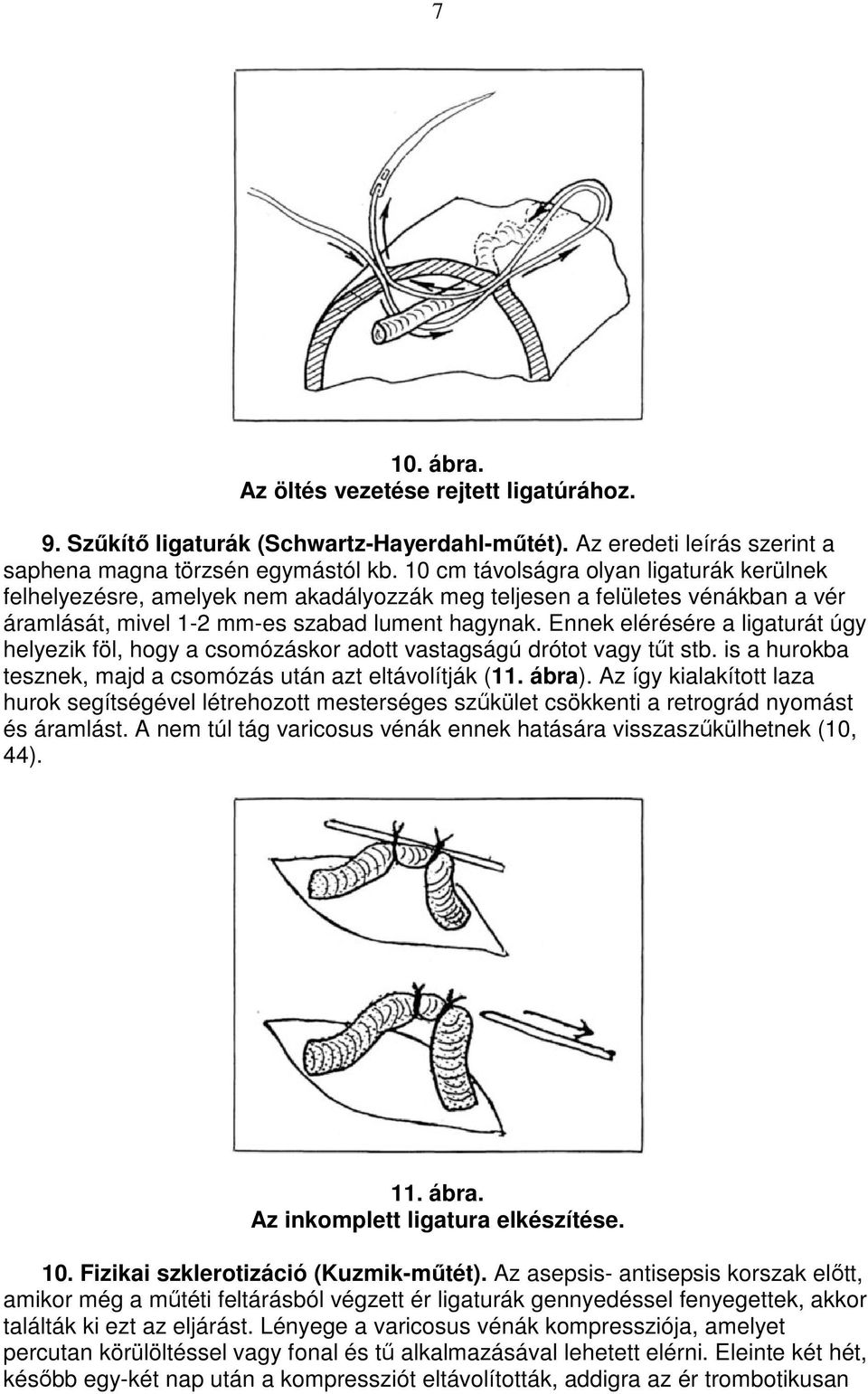 Ennek elérésére a ligaturát úgy helyezik föl, hogy a csomózáskor adott vastagságú drótot vagy tőt stb. is a hurokba tesznek, majd a csomózás után azt eltávolítják (11. ábra).