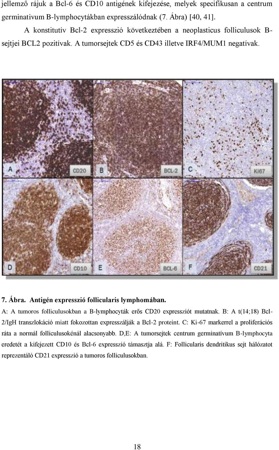 Antigén expresszió follicularis lymphomában. A: A tumoros folliculusokban a B-lymphocyták erős CD20 expressziót mutatnak.