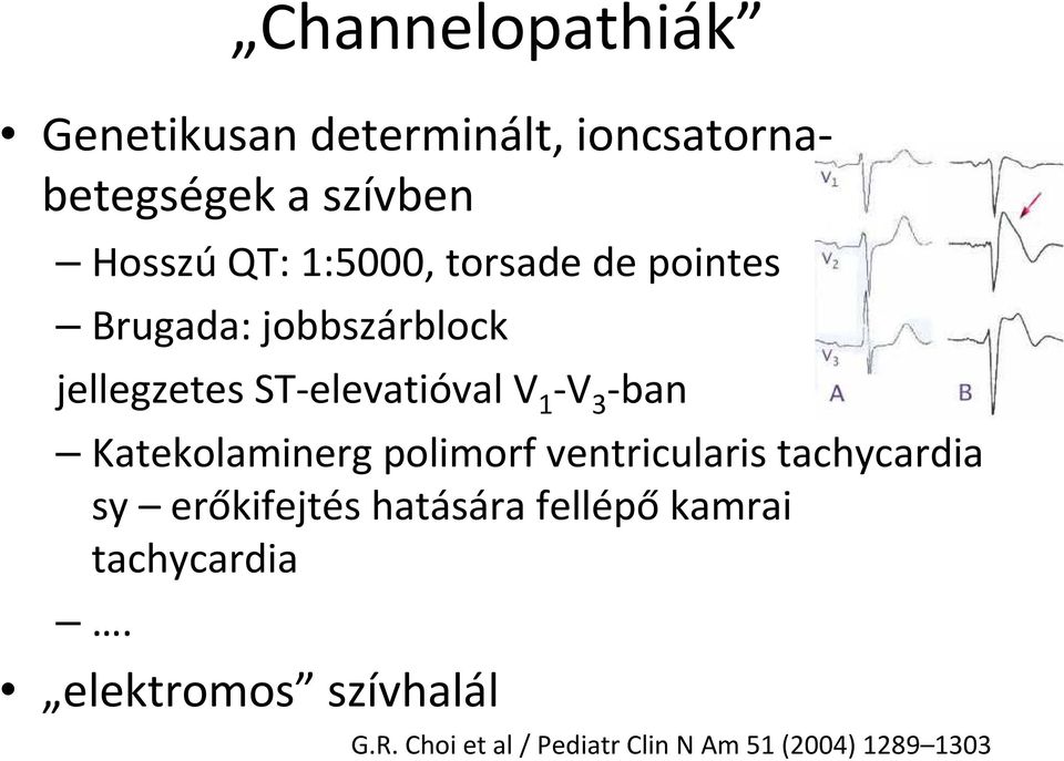 -ban Katekolaminerg polimorf ventricularis tachycardia sy erőkifejtés hatására